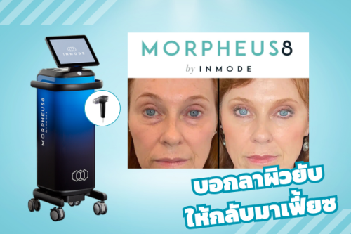 Morpheus8 (มอร์เฟียส) บอกลาผิวยับ ให้กลับมาเฟี้ยซ